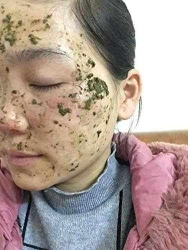 Nguyen Thi Tuyet Linh stolarija u boji-čudo od prirode-biljna trava specijalni tretman acne-melasma-pege