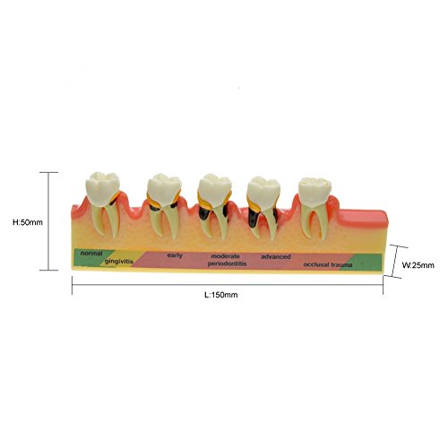 Zubni parodontni bolest Model zuba, Typodont nastavni model za studiju zubne zube